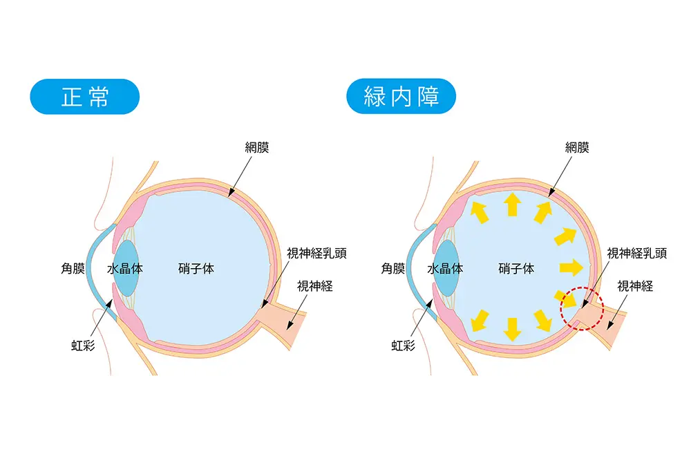 正常な眼と緑内障の眼を比較し、眼圧上昇による視神経への影響を示した模式図。