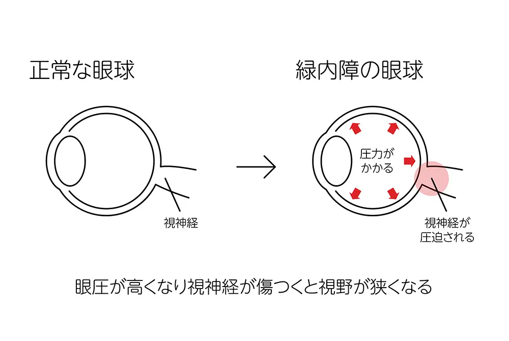 正常な眼球と緑内障の眼球を比較し、眼圧上昇による視神経圧迫を示した図。
