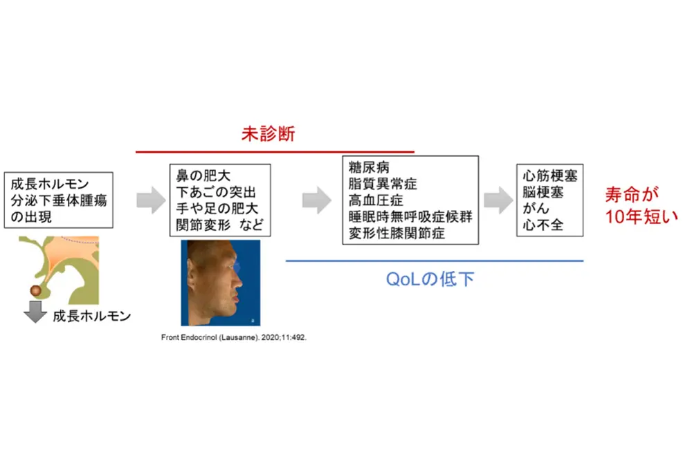 先端巨大症の症状進行と合併症を示した図。