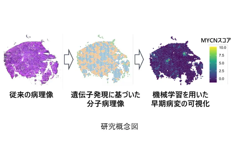 遺伝子発現データと機械学習による早期病変可視化の研究概念図。