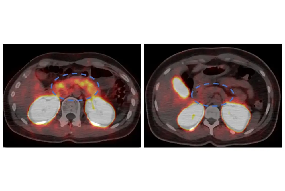 1型糖尿病患者と健常者の膵臓領域を比較したPET/CT画像