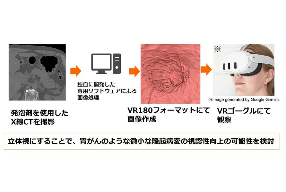 発泡剤を用いたX線CT撮影から画像処理を経て、VRゴーグルで胃内部を観察するPRVG検査システムの流れを示した図