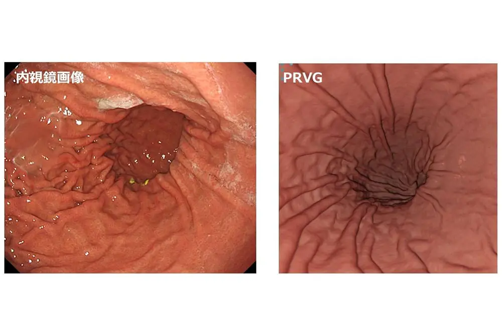 通常の胃内視鏡画像と、写真的仮想胃内視鏡（PRVG）画像を並べて比較した図