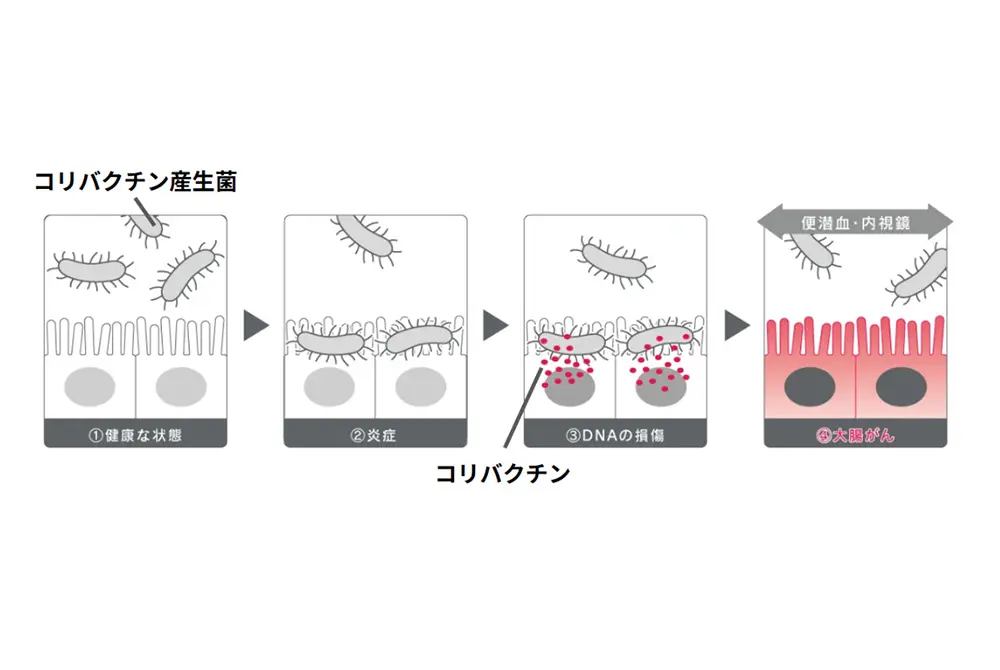 コリバクチン産生菌による腸内環境の変化と大腸がん発生までの過程を示した模式図