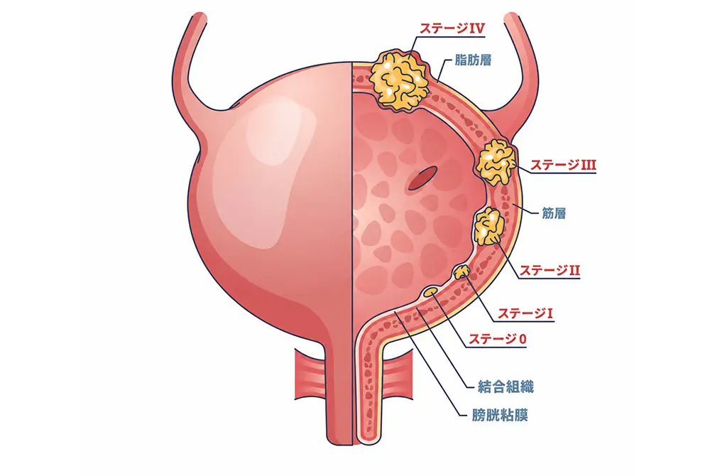 膀胱がんの進行度をステージ0からステージIVまで示した膀胱の断面図。