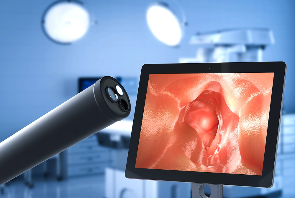 内視鏡カメラと、モニターに映し出された大腸内部の病変を示す画像。