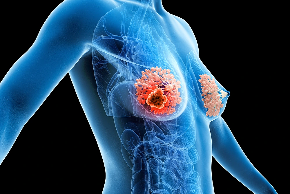 乳房内の腫瘍を示した、乳がんの医療イメージ図。