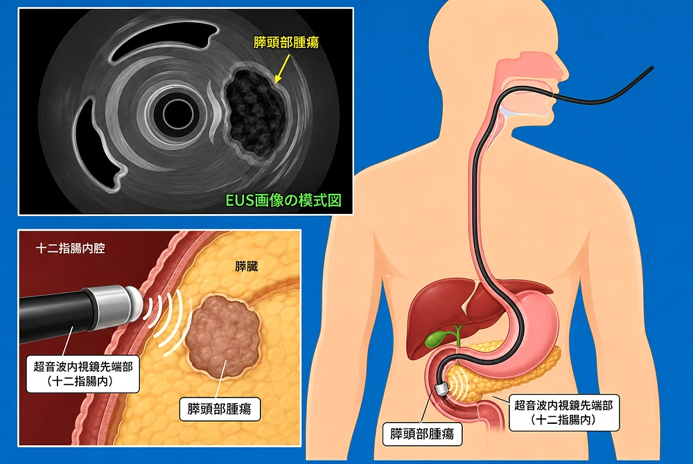 超音波内視鏡を十二指腸から挿入し、膵頭部腫瘍を観察する仕組みを示した模式図。