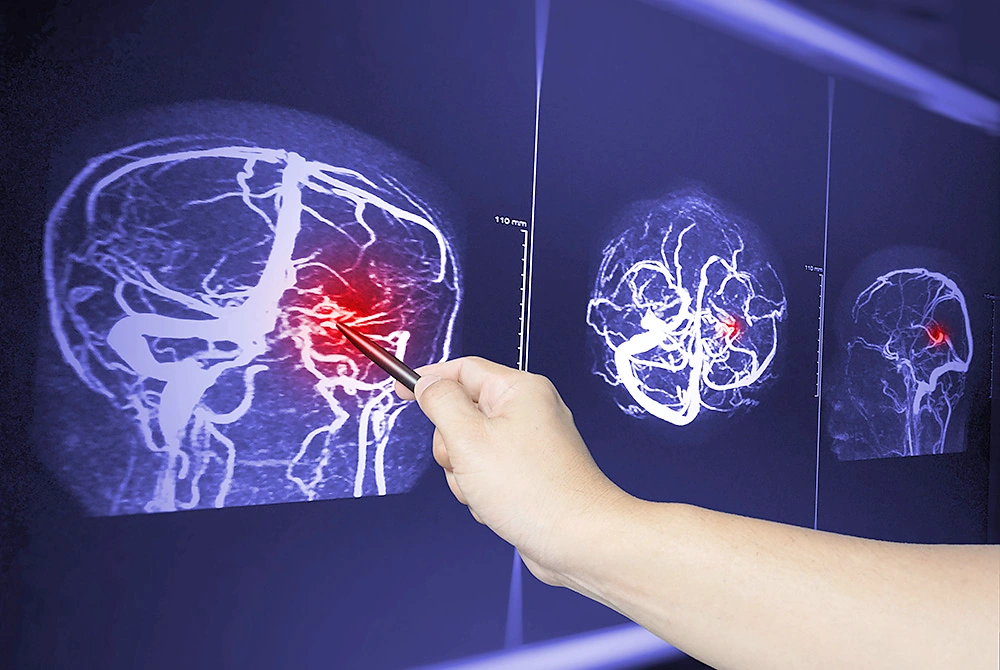 医療従事者が脳血管の画像を指し示しながら確認している様子。