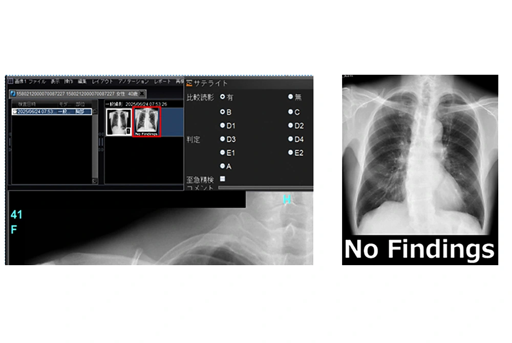 胸部X線画像診断支援プログラムが、異常所見の疑いが低い画像に「No Findings」と表示している読影端末の画面。
