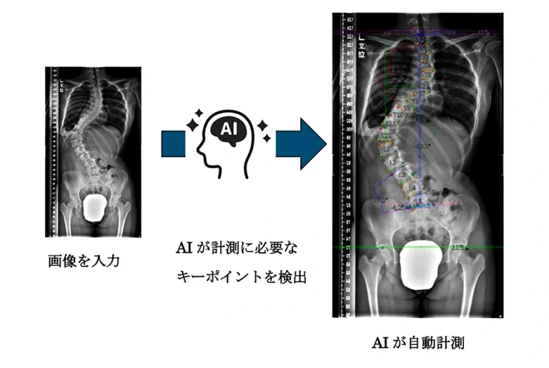 側わん症のX線画像をAIが解析し、背骨の計測点や角度を自動で検出する流れを示した図。