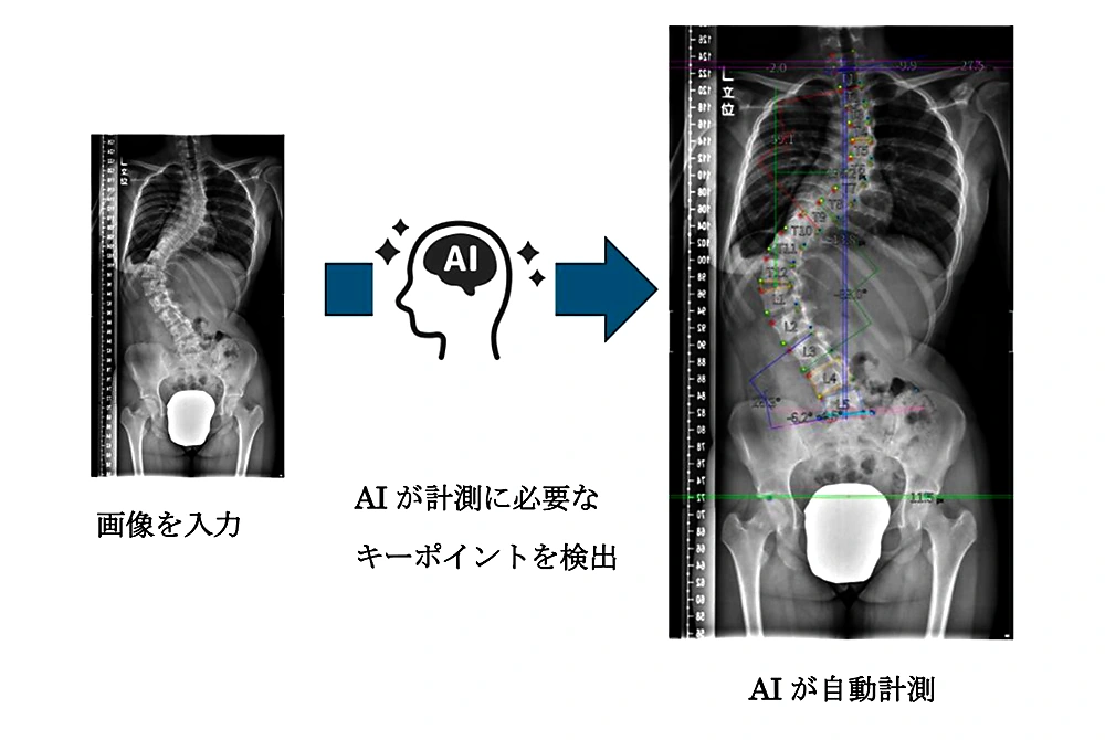 側わん症のX線画像をAIが解析し、背骨の計測点や角度を自動で検出する流れを示した図。
